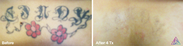 Before and after tattoo removal